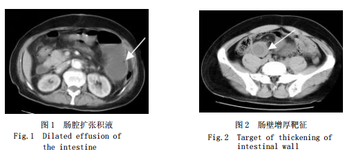 绞窄性肠梗阻 MDCT 表现