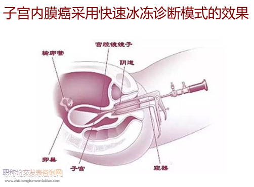 子宫内膜癌采用快速冰冻诊断模式的效果